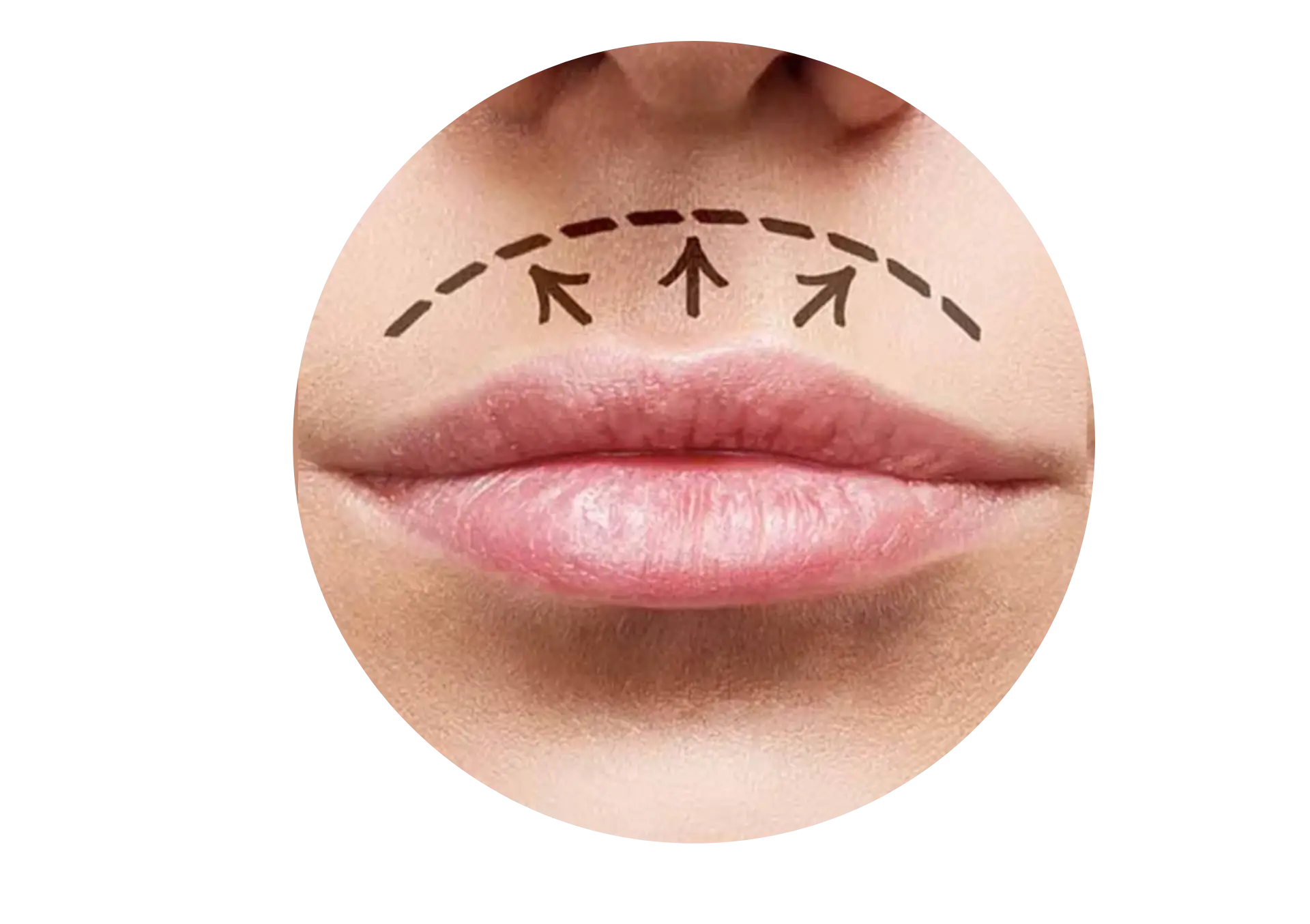 LipLift (подтяжка верхней губы)