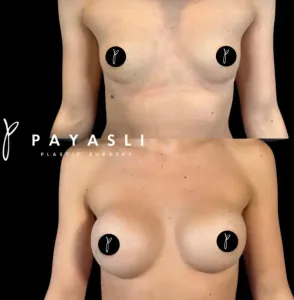 meme-estetigi-once-sonra